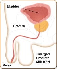 Enlarged Prostate