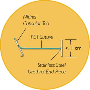 Image of UroLift<sup>®</sup> Implant