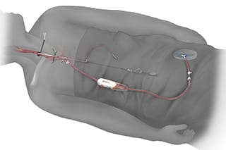 Illustration of the TCAR procedure