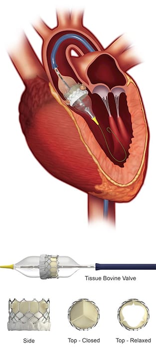 Image of tissue bovine valve replacement 