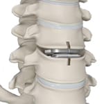 Artificial Discs (Cervical)