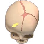 Craniosynostosis