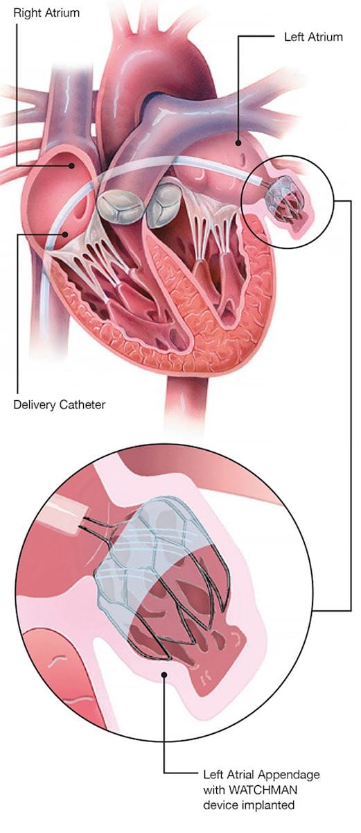 Heart with WATCHMAN Implant with delivery cathedter