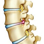 Herniated Disc