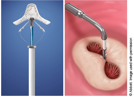 Photos of the MitraClip device and illustration of the MitraClip closing the valve