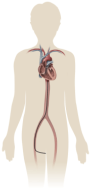 Diagram of the pathway to through groin to heart and mitral valve