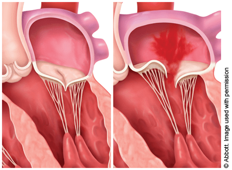 close up of normal mitral valve and prolapsed mitral valve