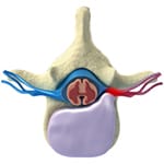 Herniated thoracic disc