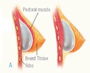 placing the implant