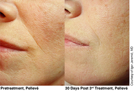 Pelleve Lip Treatments