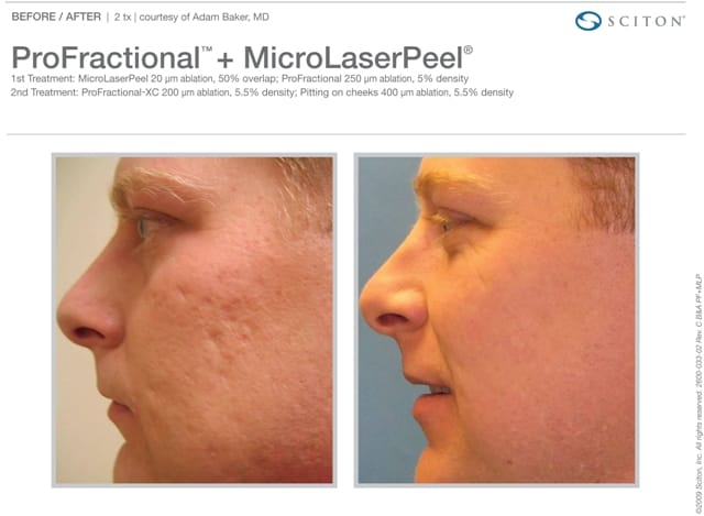 MicroLaserPeel Cheek