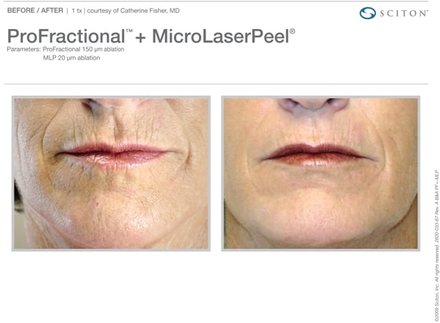 MicroLaserPeel Lips