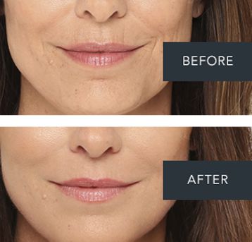 Before and After photos of a face treated with Radiesee Filler. 